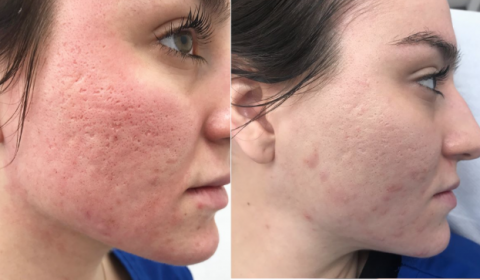 acne-scar-480x280