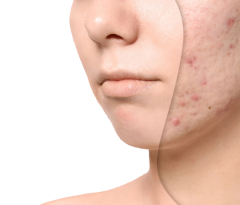 acne-scars-treatment
