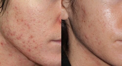 photodynamic-acne-treatment